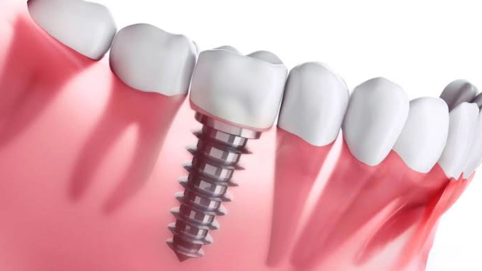 Implantes